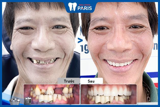 Nhổ hết các răng hàm trên và cấy 5 trụ Implant cho khách hàng bị viêm nha chu nghiêm trọng