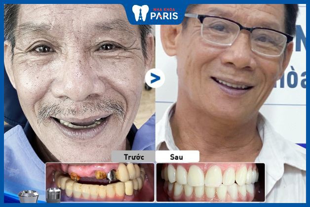 Khách hàng mất răng hàm trên, cầu răng cũ hỏng sau khi trồng răng Implant All On 4 