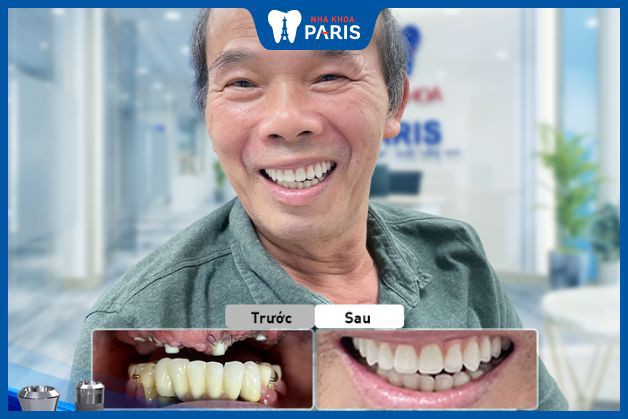 Cấy Implant All On với 5 trụ khắc phục tình trạng mất toàn bộ răng hàm do viêm nha chu, tiêu xương không đều, có gai xương