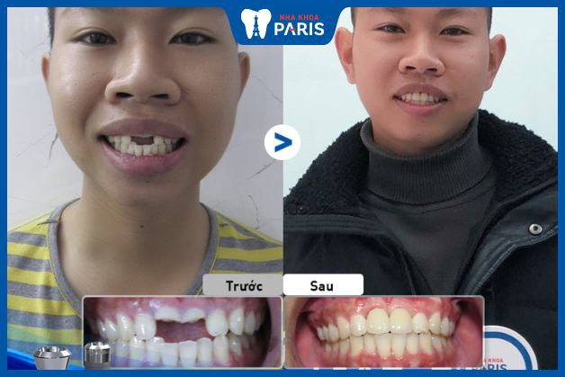 Cấy ghép răng Implant khôi phục 2 răng cửa bị mất