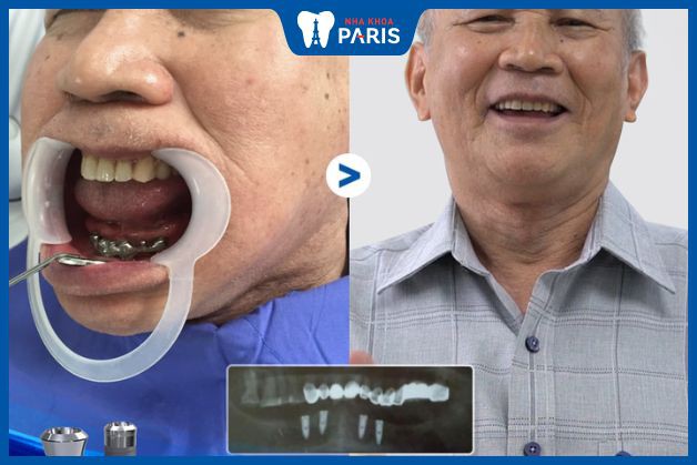 Cấy ghép 4 răng Implant cho khách hàng 82 tuổi bị mất toàn bộ răng hàm dưới, có bệnh Parkinson và loãng xương