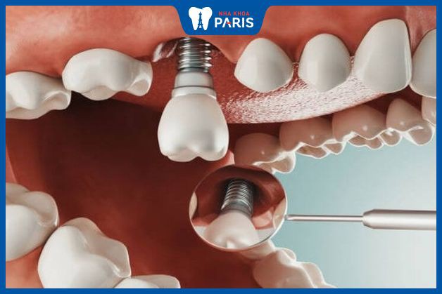 Hình ảnh trồng răng Implant tại nha khoa paris