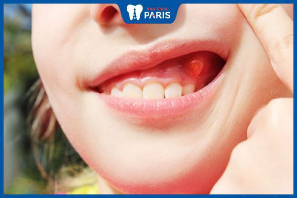 Hiểu sâu về Viêm nướu răng: Qua Hình ảnh thực tế