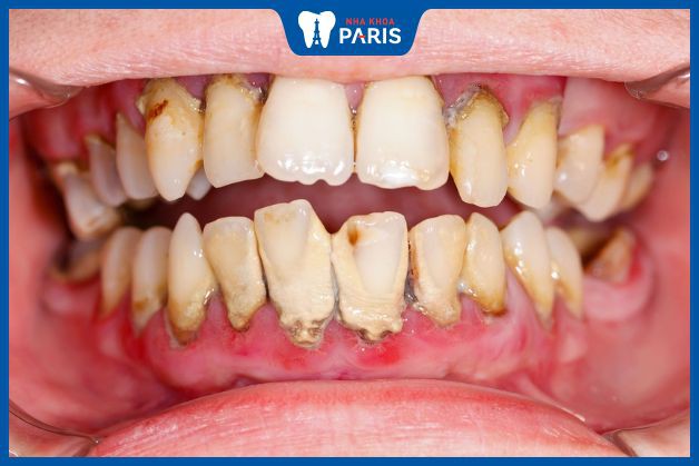 Bệnh viêm nướu răng ở giai đoạn nghiêm trọng