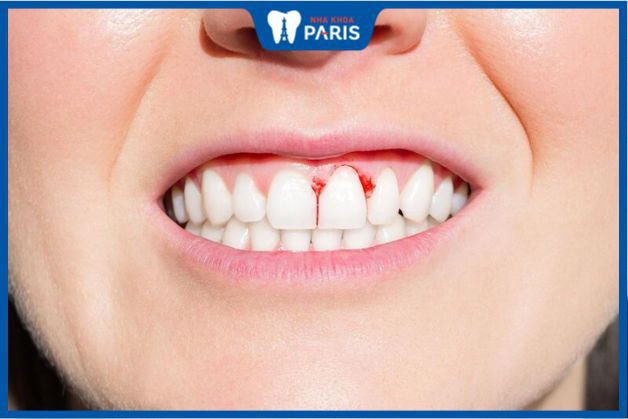 Chân răng dễ bị chảy máu khi viêm nướu