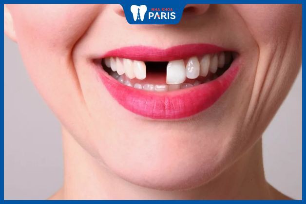 Nhổ răng cửa có nguy hiểm không