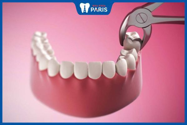 Răng số 6 có nhổ được không – 4 ảnh hưởng khi mất răng