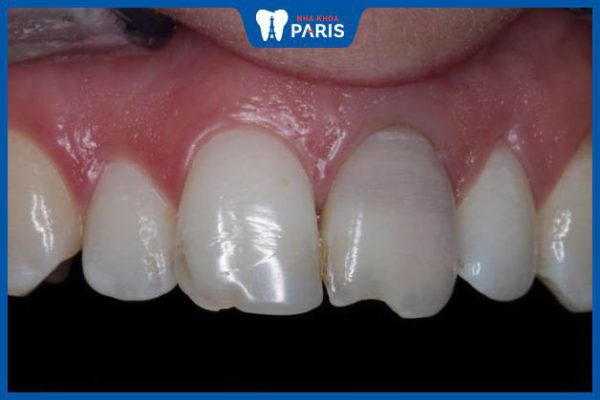 Răng sứt mẻ: Nguyên nhân và phương pháp xử lý hiệu quả