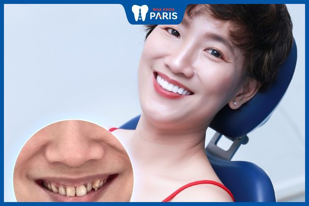 Review của khách hàng bọc răng sứ tại Nha Khoa Paris Đà Nẵng