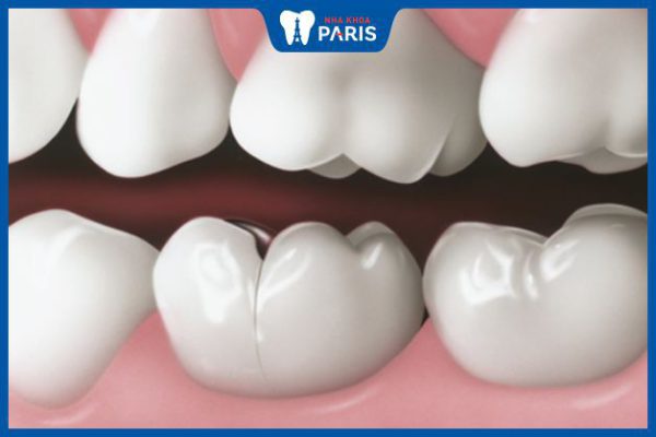 Bị nứt răng hàm: Nguyên nhân và cách khắc phục hiệu quả