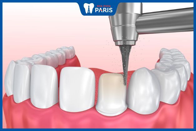 Mài răng sai cách có thể khiến răng nhạy cảm hơn và dễ bị chảy máu