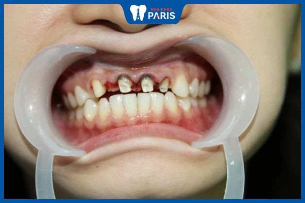 Rủi ro khi bọc răng sứ kém chất lượng