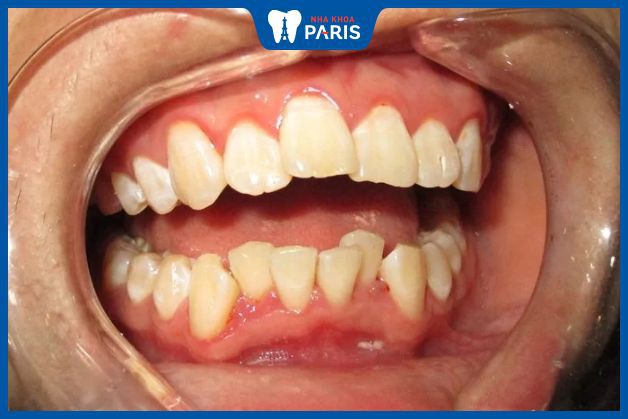 Bọc răng sứ có thể giải quyết tình trạng răng hô không?