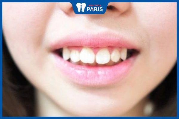 Bọc răng sứ khắc phục răng cửa hô vẩu | Nha khoa Paris