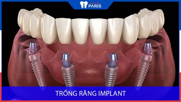 Trụ implant – Giải pháp phục hồi răng và chức năng ăn nhai