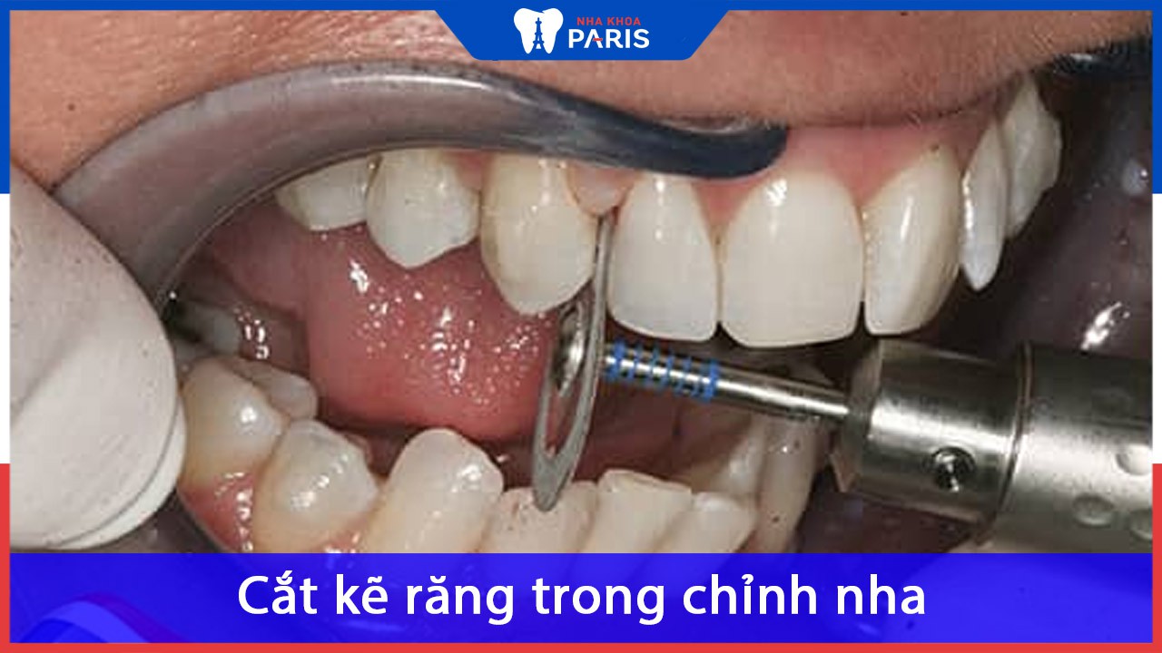 Cắt kẽ răng trong chỉnh nha: Lợi ích và quy trình thực hiện