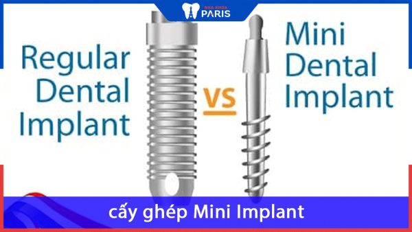 Tất tần tật về cấy ghép Mini Implant bạn cần biết