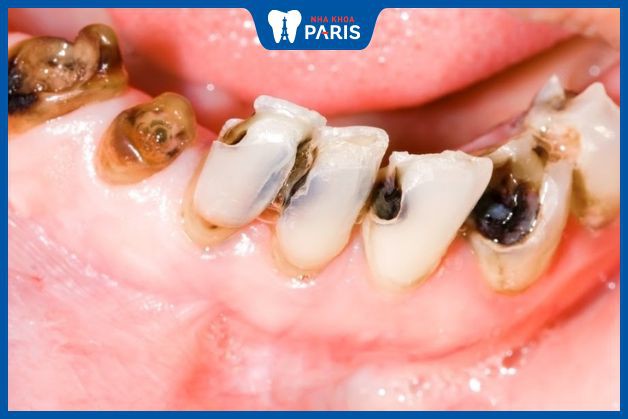 Chữa đau răng sâu bằng lá lốt có hiệu quả không?