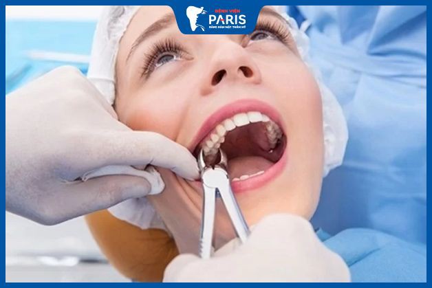 Quy trình nhổ răng cấm bị sâu chuẩn Y khoa