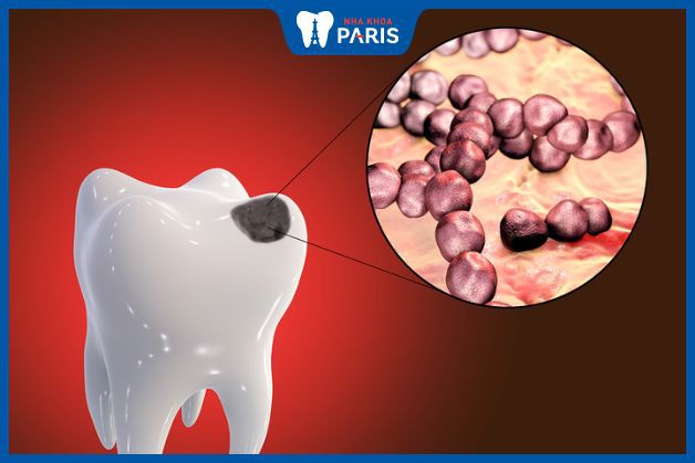 Streptococcus mutans là nguyên nhân chính gây ra sâu răng