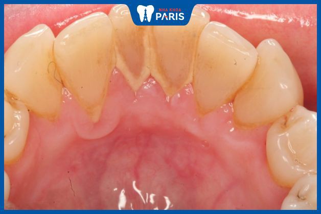 Cao răng có thể tồn tại ở cả bề mặt răng lẫn dưới nướu