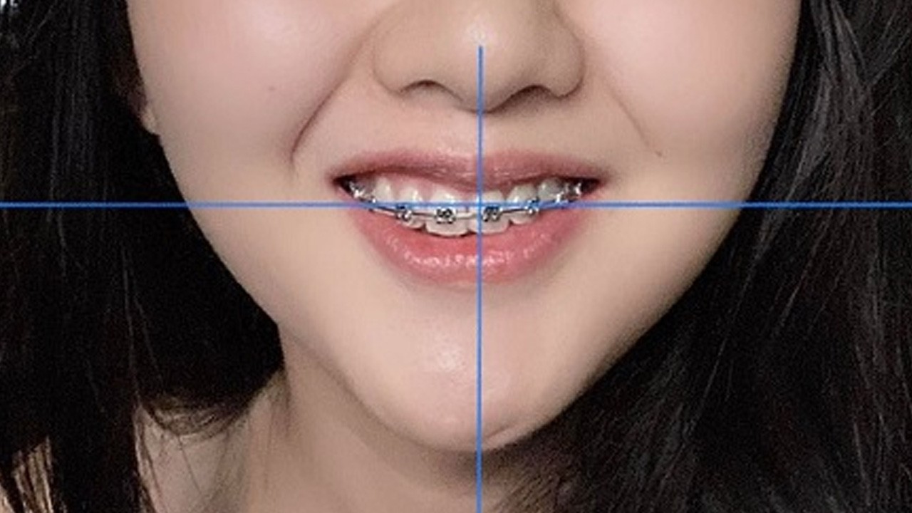 Nguyên nhân gây niềng răng không thành công: bác sĩ nha khoa tư vấn