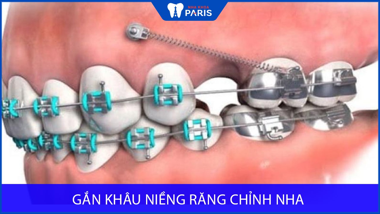 Gắn khâu niềng răng có đau không? Cách chăm sóc sau khi gắn khâu