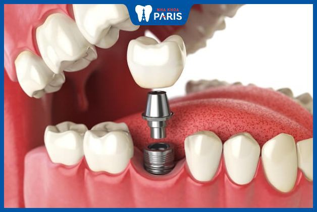 Dentium là thương hiệu trụ Implant Dio Hàn Quốc được nha khoa Paris lựa chọn