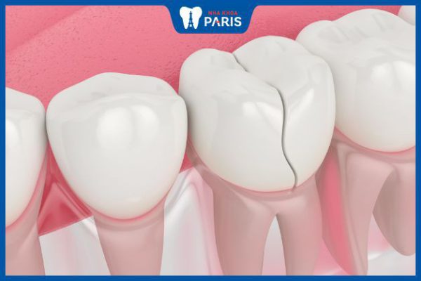 Góc giải đáp: Có nên tẩy trắng răng bị nứt răng không?