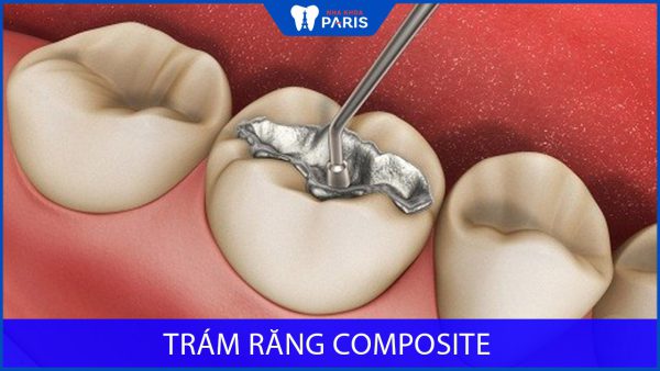 Trám răng Composite: Phương pháp trám răng an toàn và hiệu quả