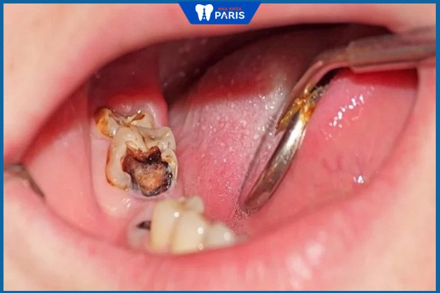 Hình ảnh viêm tủy răng