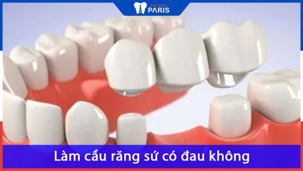 Làm cầu răng sứ có đau không? Nha khoa Paris