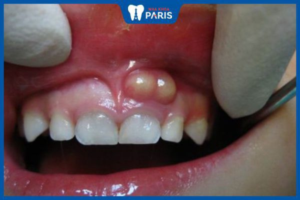 Mụn trắng nướu răng: Nguyên nhân, triệu chứng và cách phòng tránh