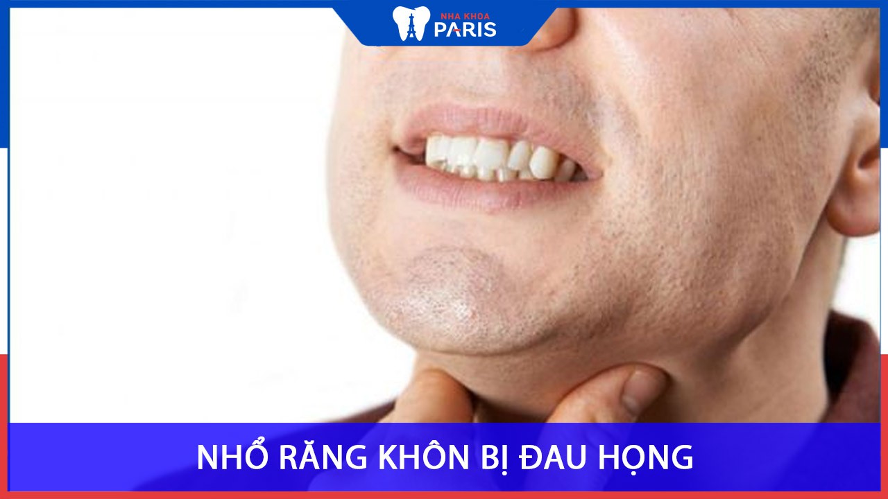 Nhổ răng khôn bị đau họng: Nguyên nhân và cách khắc phục