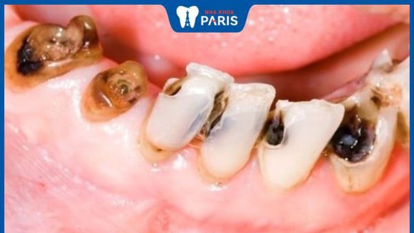 Những biểu hiện của răng bị sâu? Khi nào cần nhổ răng sâu