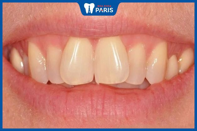 Những trường hợp nào nên bọc răng sứ cải hiện hàm răng hô vẩu