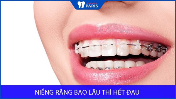 Niềng răng bao lâu thì hết đau và cách giảm đau hiệu quả
