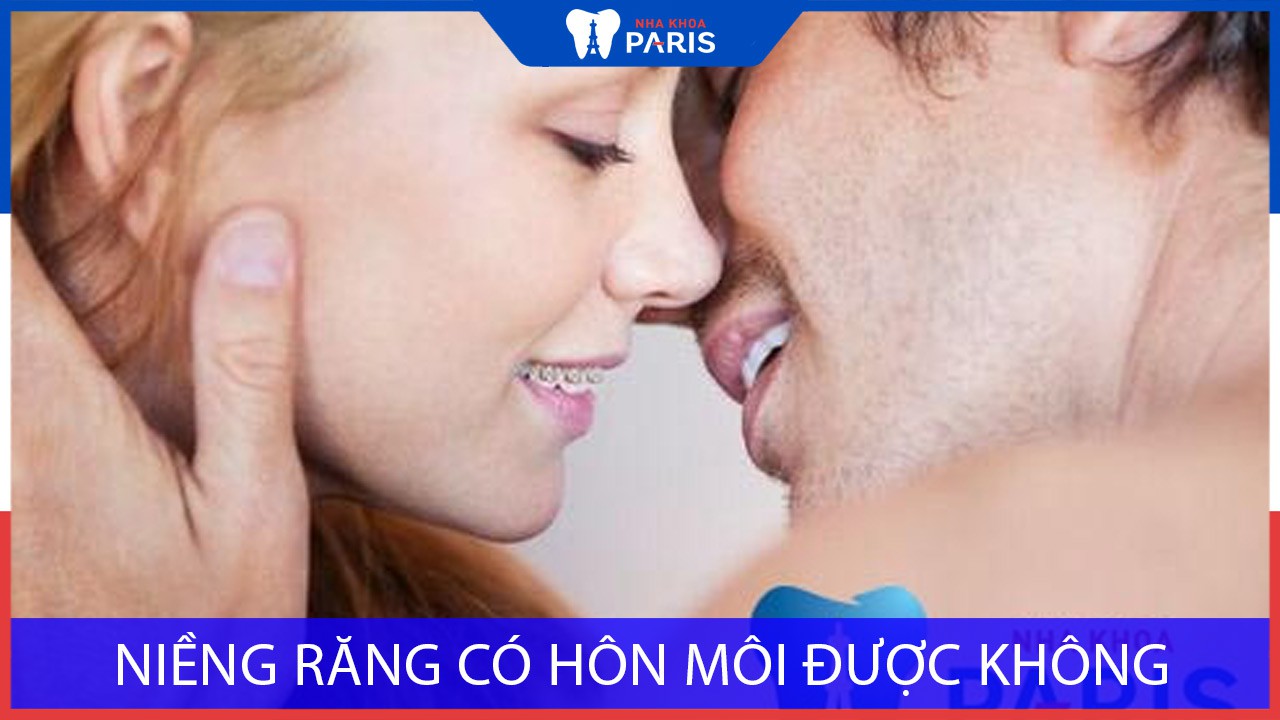 Niềng răng có hôn môi được không? Nha khoa Paris