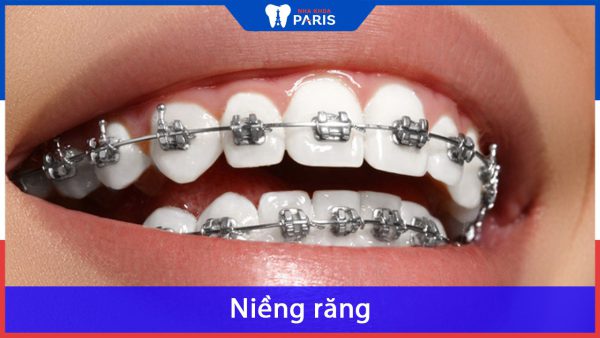 Niềng răng bao nhiêu tiền tại Nha Khoa Paris tiêu chuẩn Pháp