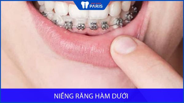 Niềng răng Invisalign có đau không, nha khoa paris giải đáp