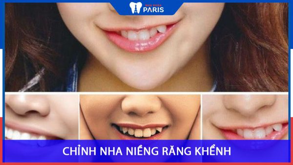 Niềng răng khểnh có nên không? Các phương pháp phổ biến