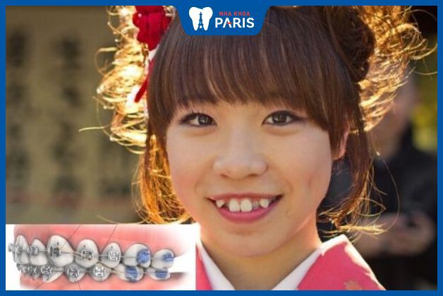 Niềng răng ở Nhật giá bao nhiêu? Có đắt không?