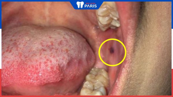 Nổi cục máu bầm trong miệng: Nguyên nhân và cách điều trị