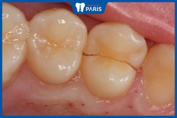 Nứt răng có đau không? Những hậu quả khi bị nứt răng