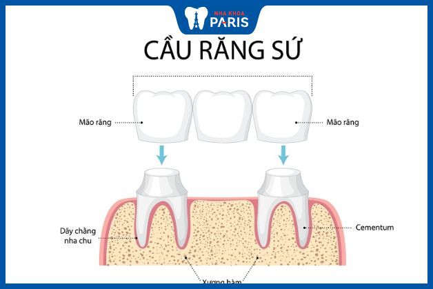 Phương pháp trồng 4 răng cửa với cầu răng sứ