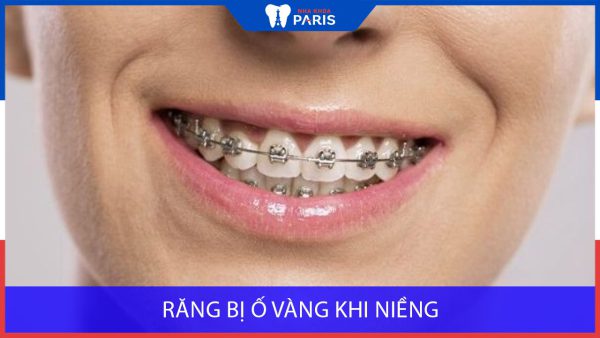 Răng bị ố vàng khi niềng: Cách ngăn ngừa hiệu quả