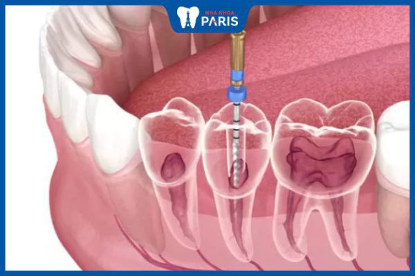 Răng đã lấy tủy tồn tại được bao lâu – Hỏi đáp cùng bác sĩ
