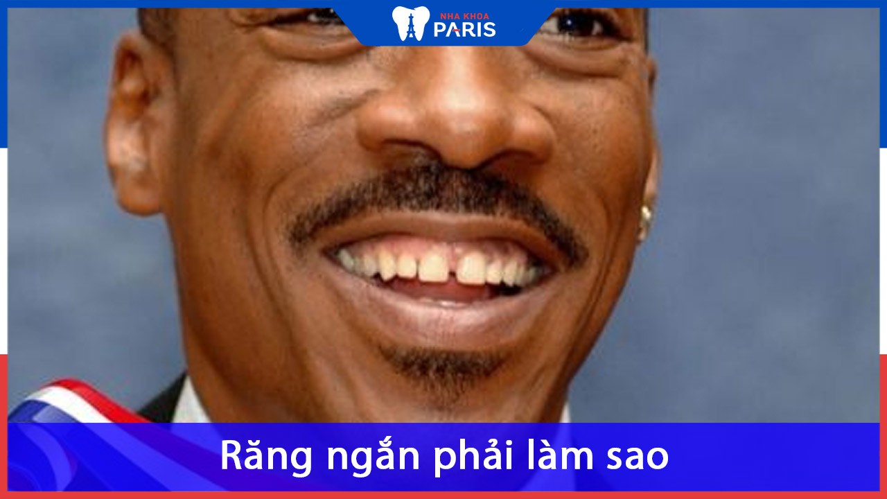 Răng ngắn phải làm sao? Tại sao răng lại ngắn và cách phòng ngừa