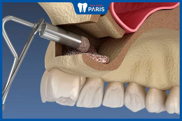 Tại sao phải phẫu thuật ghép xương hàm khi trồng răng Implant