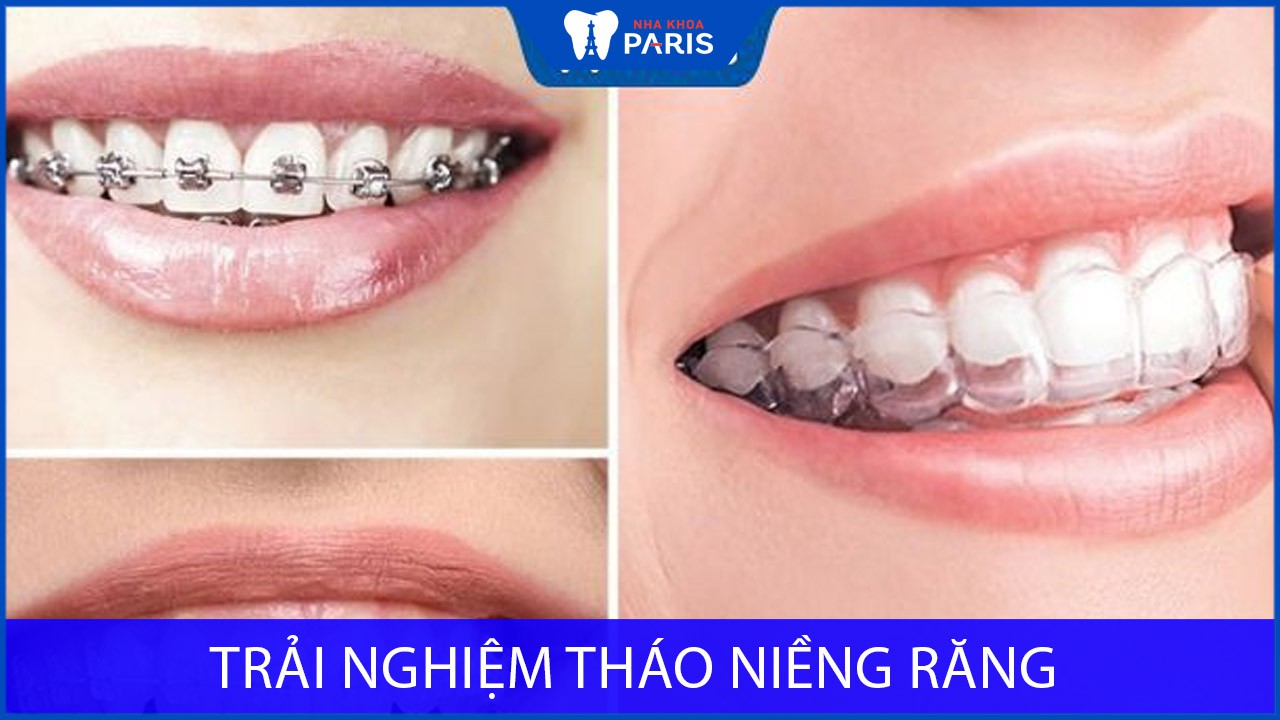 Trải nghiệm tháo niềng răng: Từ giã những bất tiện